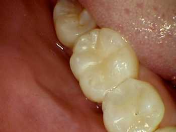 after photo of the decay filled with white fillings