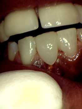 after photo of temporary replacement of the gold tooth that was taken out with a white tooth